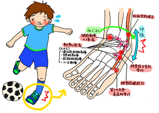 足首をひねった場面と足関節の靭帯損傷部位を示したイラスト