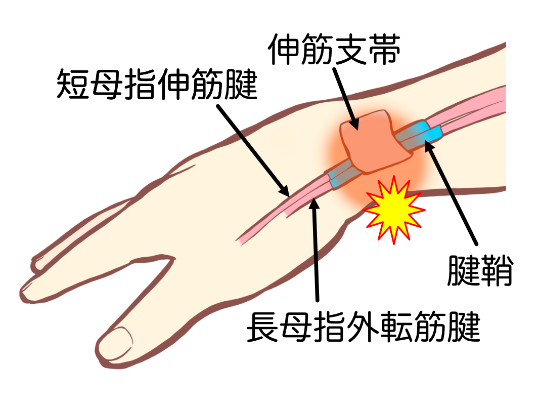 腱鞘炎の種類と、痛みを取るために大事な考え方 ✋🖱️