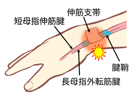 腱鞘炎の種類と、痛みを取るために大事な考え方 ✋🖱️