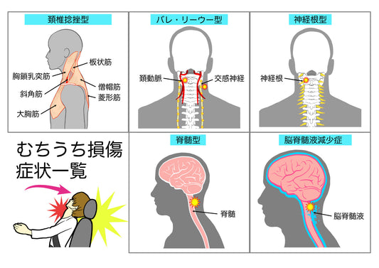 頚椎捻挫や神経症状など事故後の首の症状を説明する図