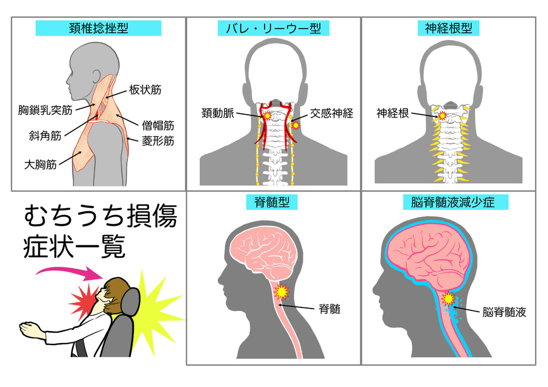 事故後の痛みが天気で悪化する？｜気圧とむちうちの関係